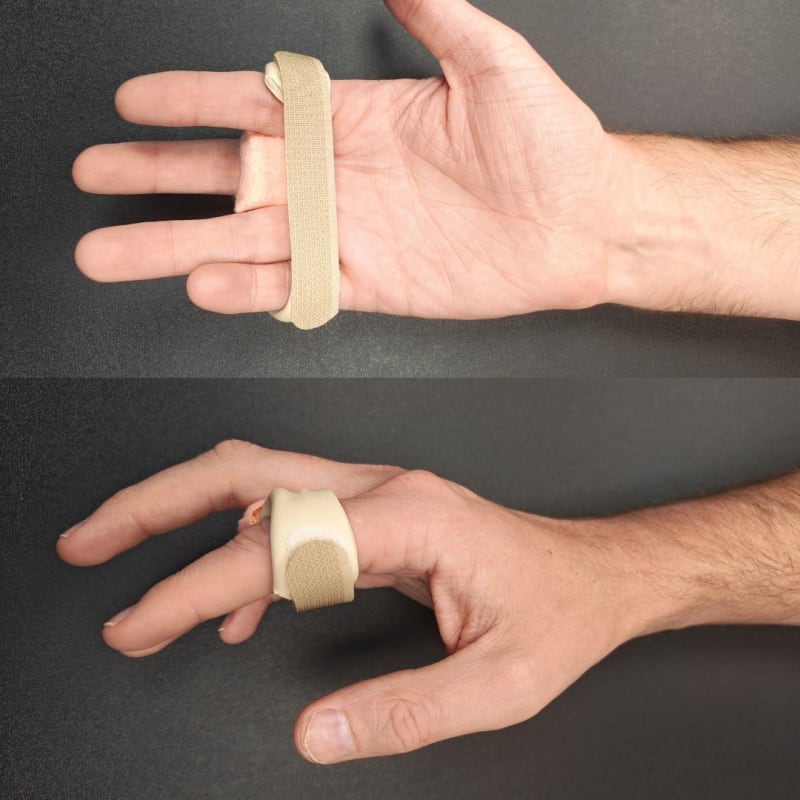 Relative motion extension yoke orthosis on the middle finger for a sagittal band rupture, shown from the palm and from the side.