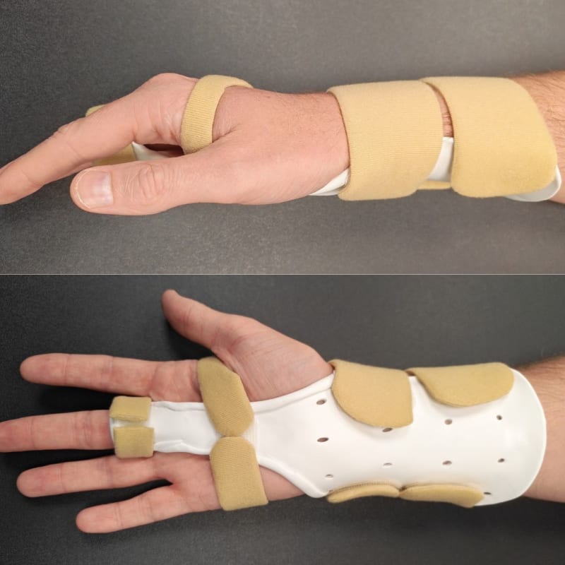 Wrist inclusive orthosis variant for a middle finger sagittal band rupture, shown from the side and from the palm.