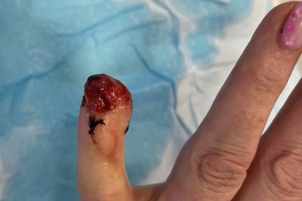 Fingertip amputation wound before Hand Therapy treatment, Belfast