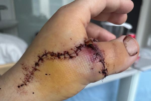 Toe-to-thumb transfer before Hand Therapy rehabilitation with Ms Michelle Razo, Belfast