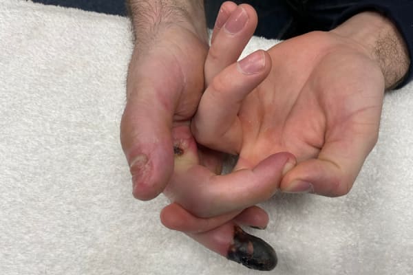 Crush injury to the hand before Hand Therapy rehabilitation with Ms Michelle Razo, Belfast