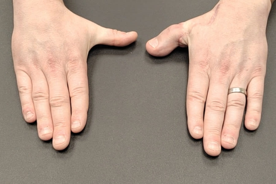Settled scars on the hand following scar therapy and Hand Therapy rehabilitation, Belfast