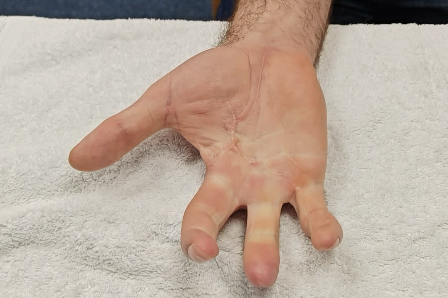 Hand crush injury scars after scar therapy and rehabilitation with Ms Michelle Razo CHT, Belfast