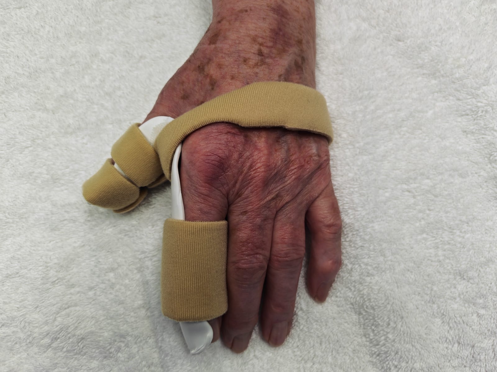 Custom thumb and finger thermoplastic splint fabricated by Ms Michelle Razo, Certified Hand Therapist Belfast