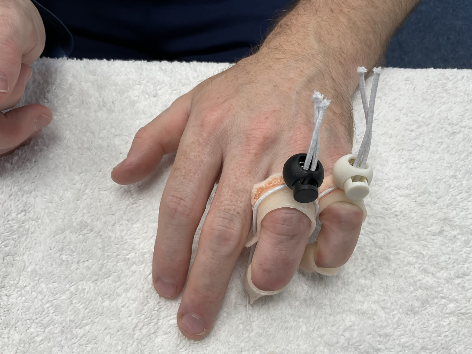 Toggle splint for a hand immobilised too long, The Hand Therapist Belfast