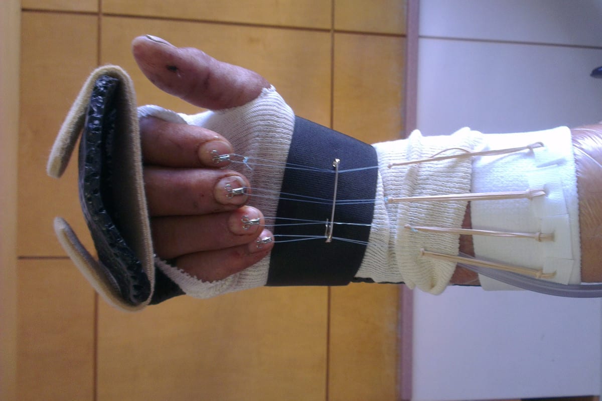 Dynamic splint fabricated by Ms Michelle Razo, Certified Hand Therapist Belfast