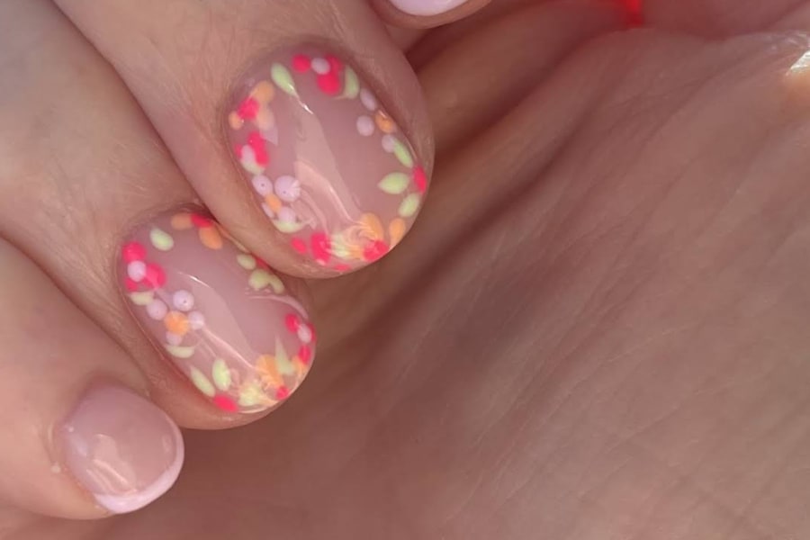 Fingertip amputation outcome after Hand Therapy rehabilitation with Ms Michelle Razo, Belfast