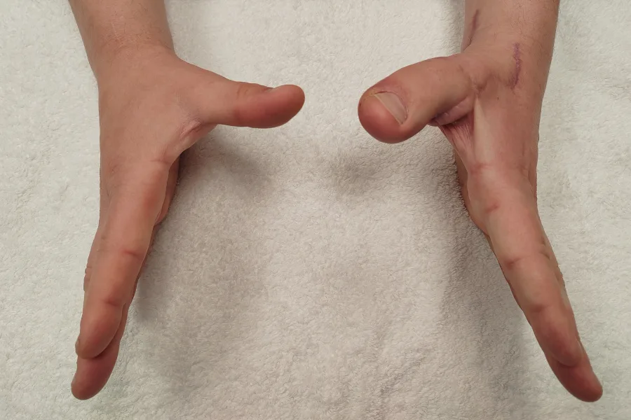 Toe to Thumb Transplant