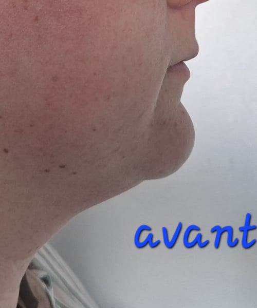 Avant lipocavitation — Silhouette Care Home