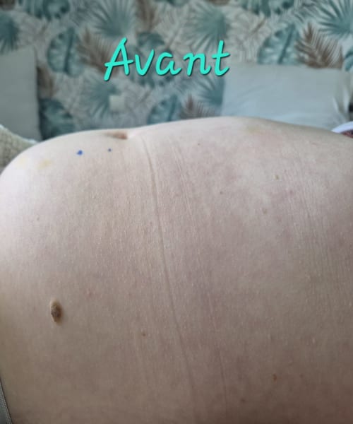 Avant lipocavitation — Silhouette Care Home