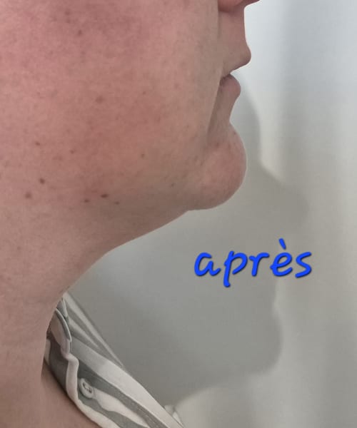 Après lipocavitation — Silhouette Care Home