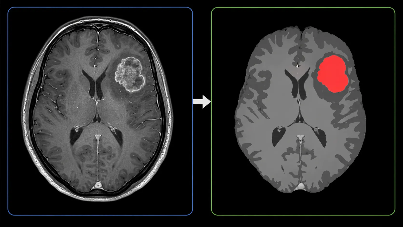 brain mri segmentation mask