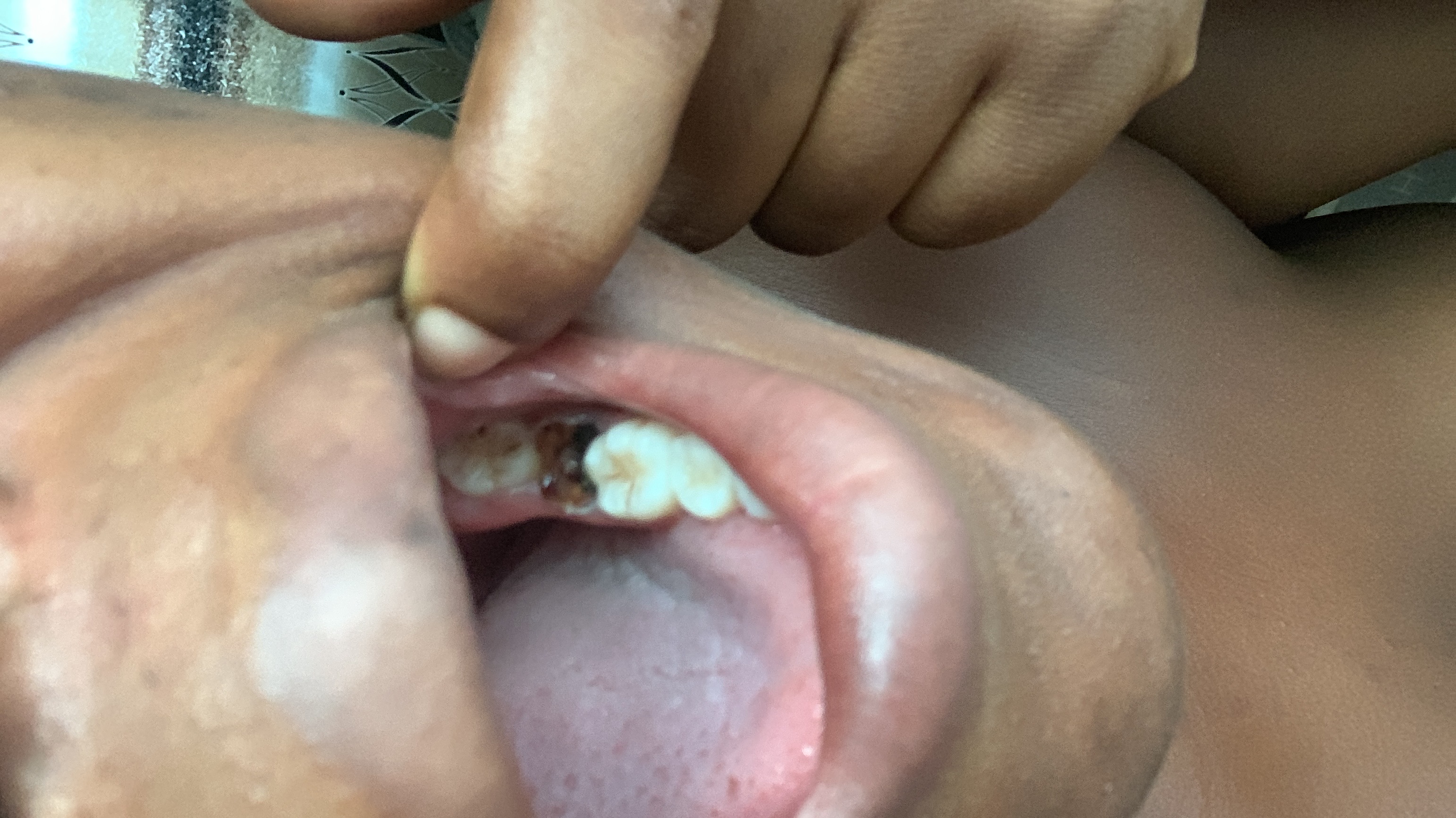 To help with my dental to procedure and brother leg procedure