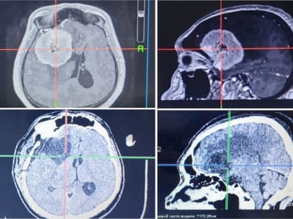 «Ювелирную» операцию провели врачи из Кузбасса: они удалили страшную опухоль головного мозга