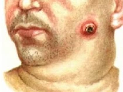 В Сибири продолжает увеличиваться количество заболевших сибирской язвой