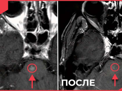 Во Владимирском онкодиспансере применяют новейшие методы радиохирургии