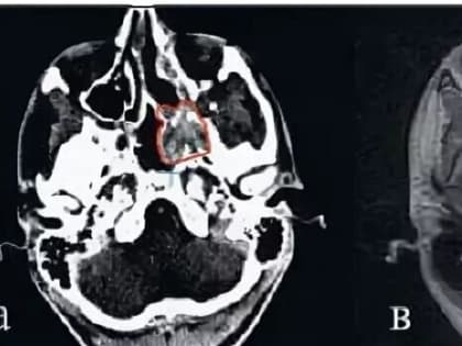 У 15-летнего подростка из Владимира нашли опасную быстрорастущую опухоль мозга