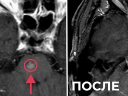 Жителя Владимира избавили от метастаза в стволе головного мозга