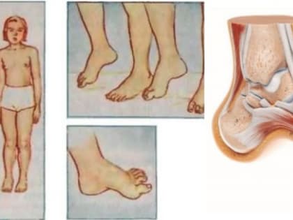 У девочки во Владимирской области обнаружили редкое генетическое заболевание