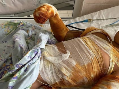 Реаниматологам областной детской больницы удалось стабилизировать состояние малыша с 40% ожогов тела