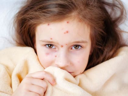 Владимирцев предупреждают о новых случаях заболевания корью в регионе