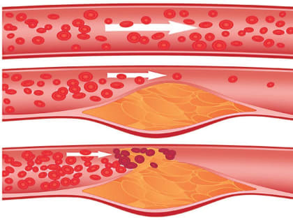 Без бляшек: продукты, которые чистят сосуды и кровь лучше, чем таблетки