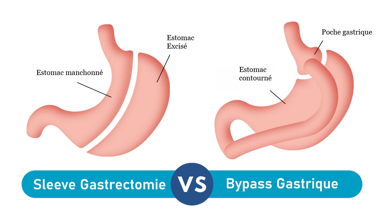 Sleeve Gastrectomie vs Bypass Gastrique