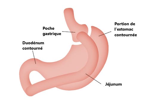 bypass gastrique