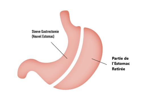 Sleeve Gastrectomie