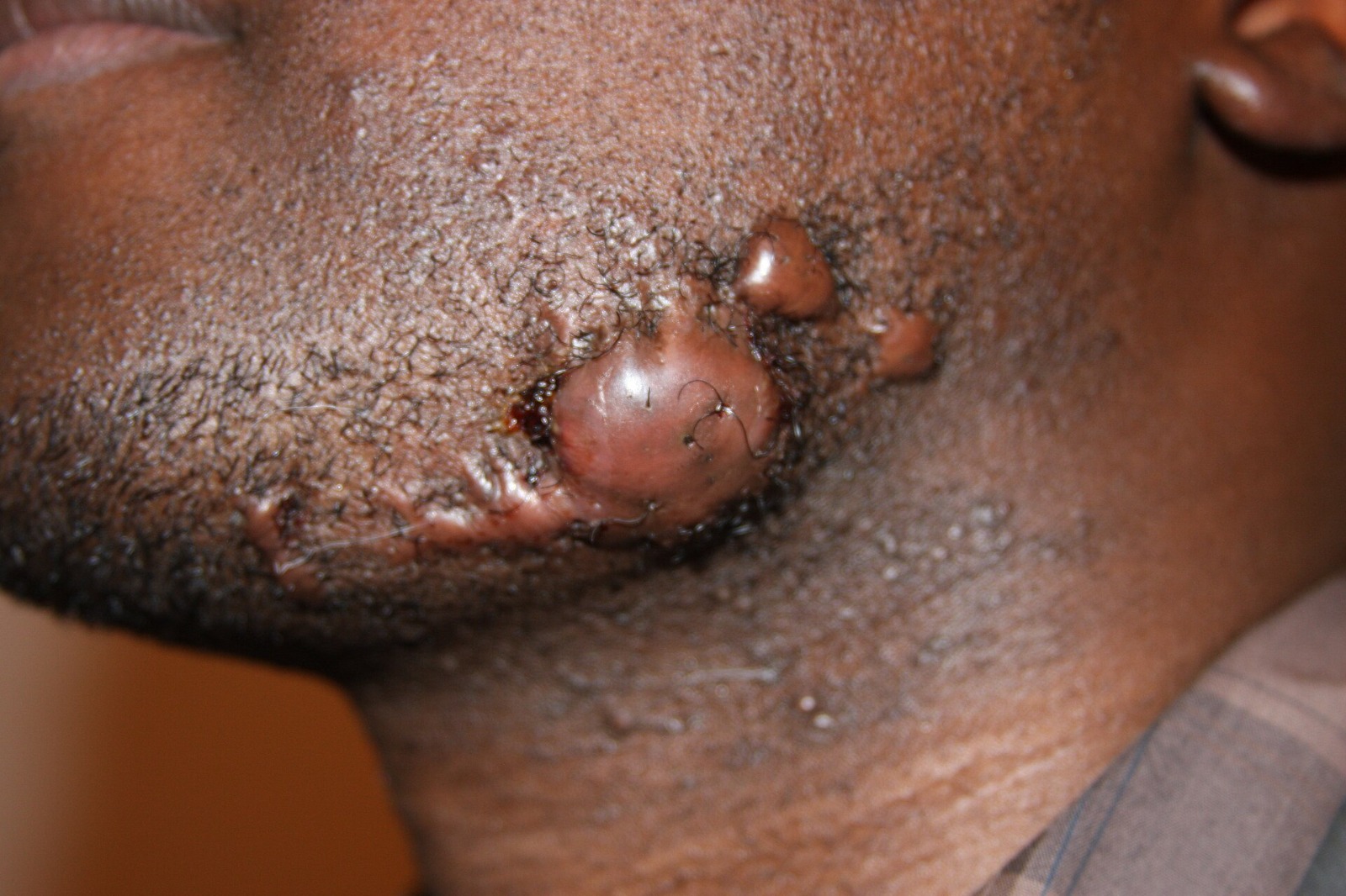 Keloid scar