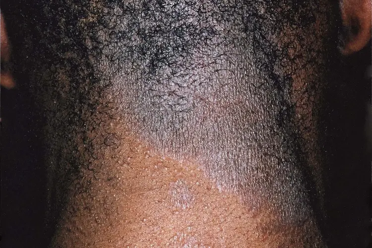 Eczema on skin