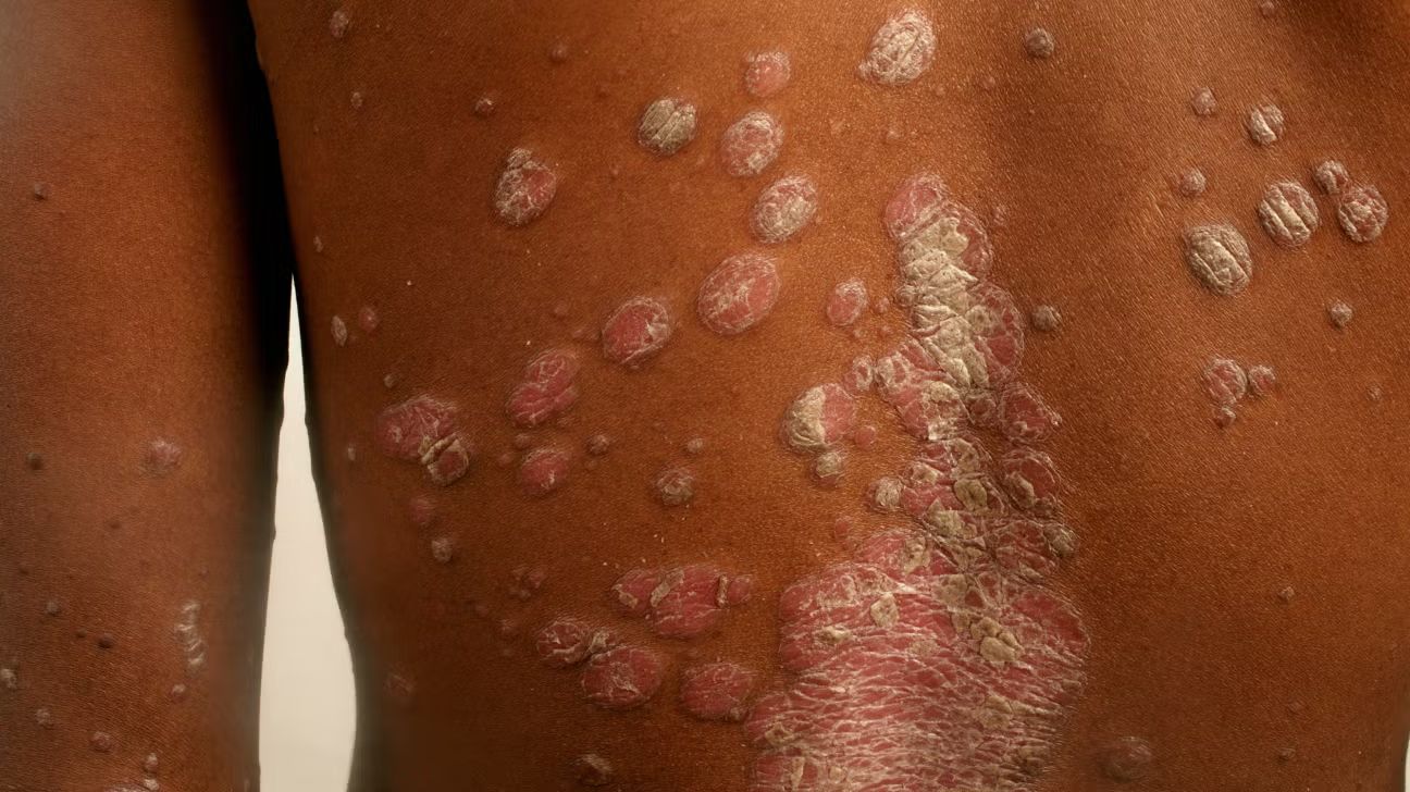 Psoriasis on skin