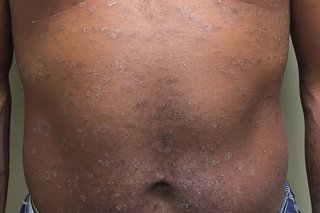 Skin infection types