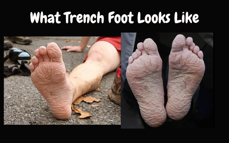 Trench Foot Looks Like