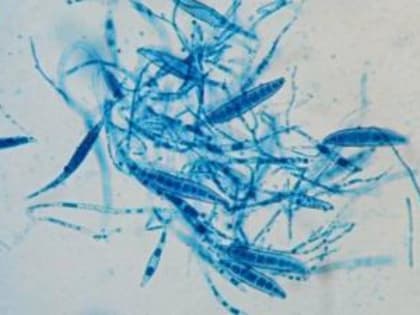 Микроспория: заболеваемость и профилактика в Березовском