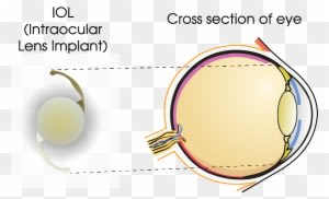 Once Implanted, With The Aid Of Advanced Technology, - Portable Network Graphics - Transparent PNG Free Download