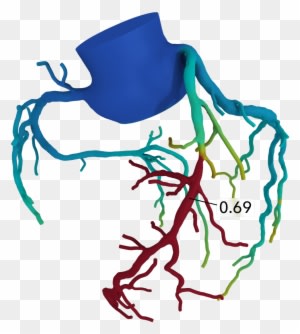 “people Ask How Can We Afford To Have These Kinds Of - Heartflow - Transparent PNG Free Download