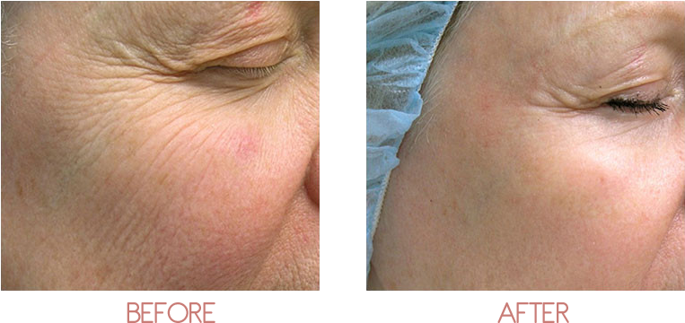 Sypien, M - Non Ablative Laser Wrinkles - Transparent PNG Free Download