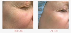 Sypien, M - Non Ablative Laser Wrinkles - Transparent PNG Free Download