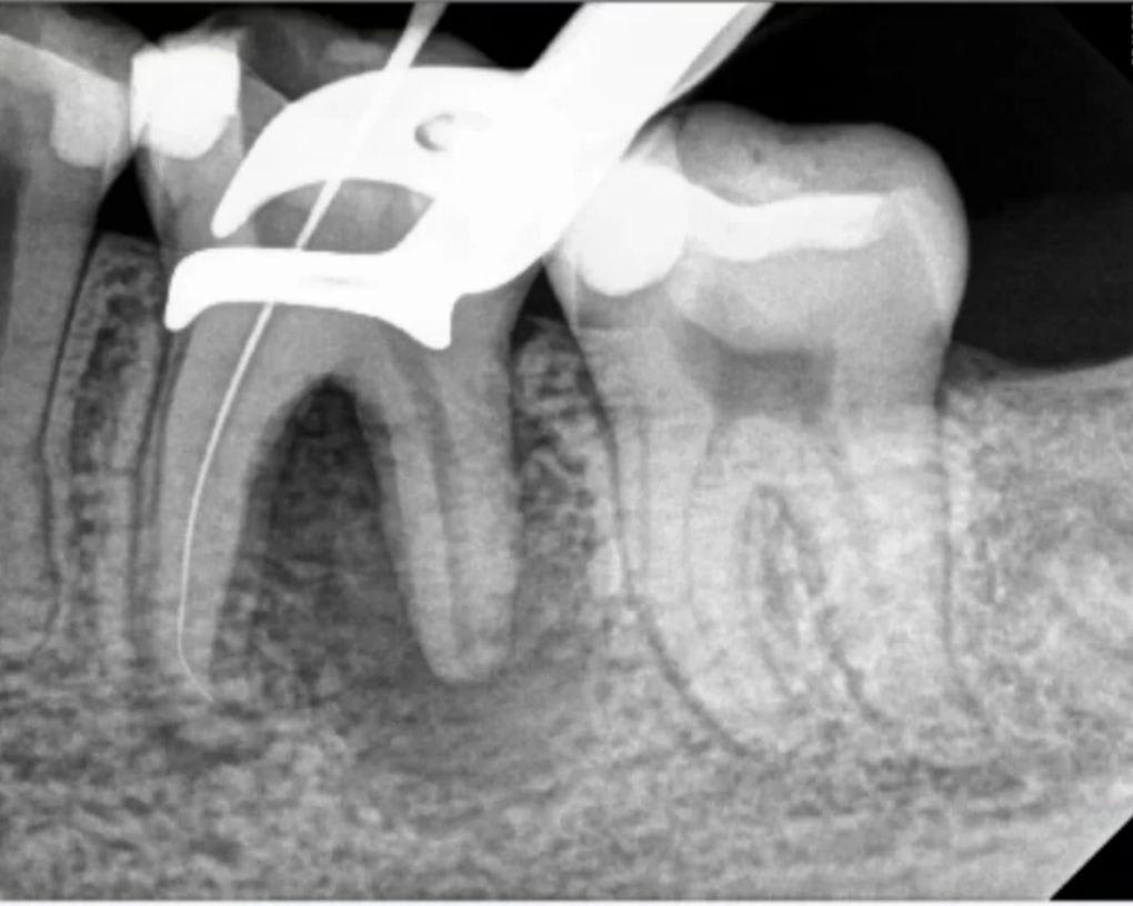 Root canal treatment performed to eliminate infection, preserve natural tooth structure, and relieve pain effectively. - Performed at DR. ZEE & Associates