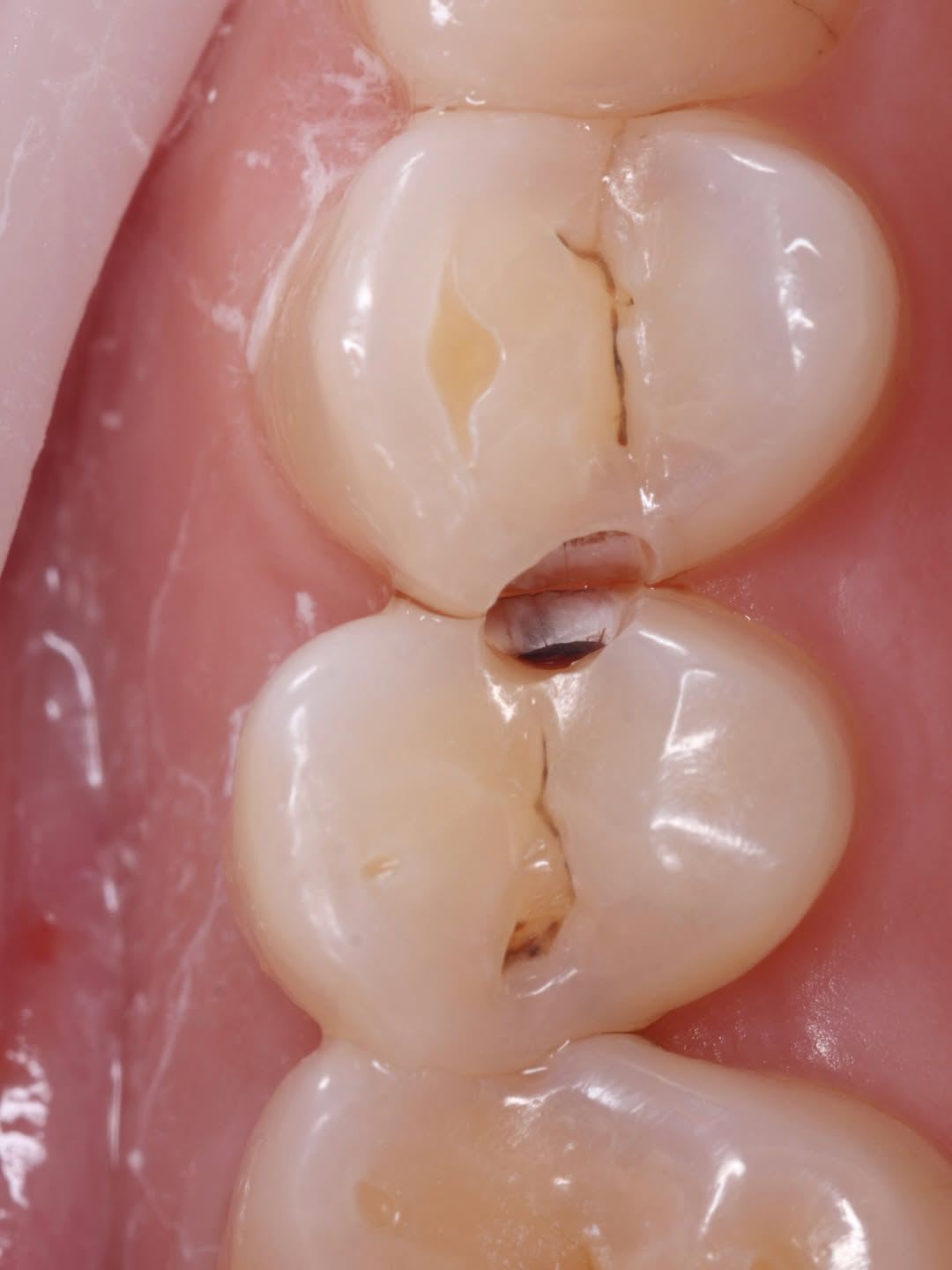 Class II composite filling performed to restore proximal caries with precise contouring and natural tooth aesthetics. - Performed at DR. ZEE & Associates