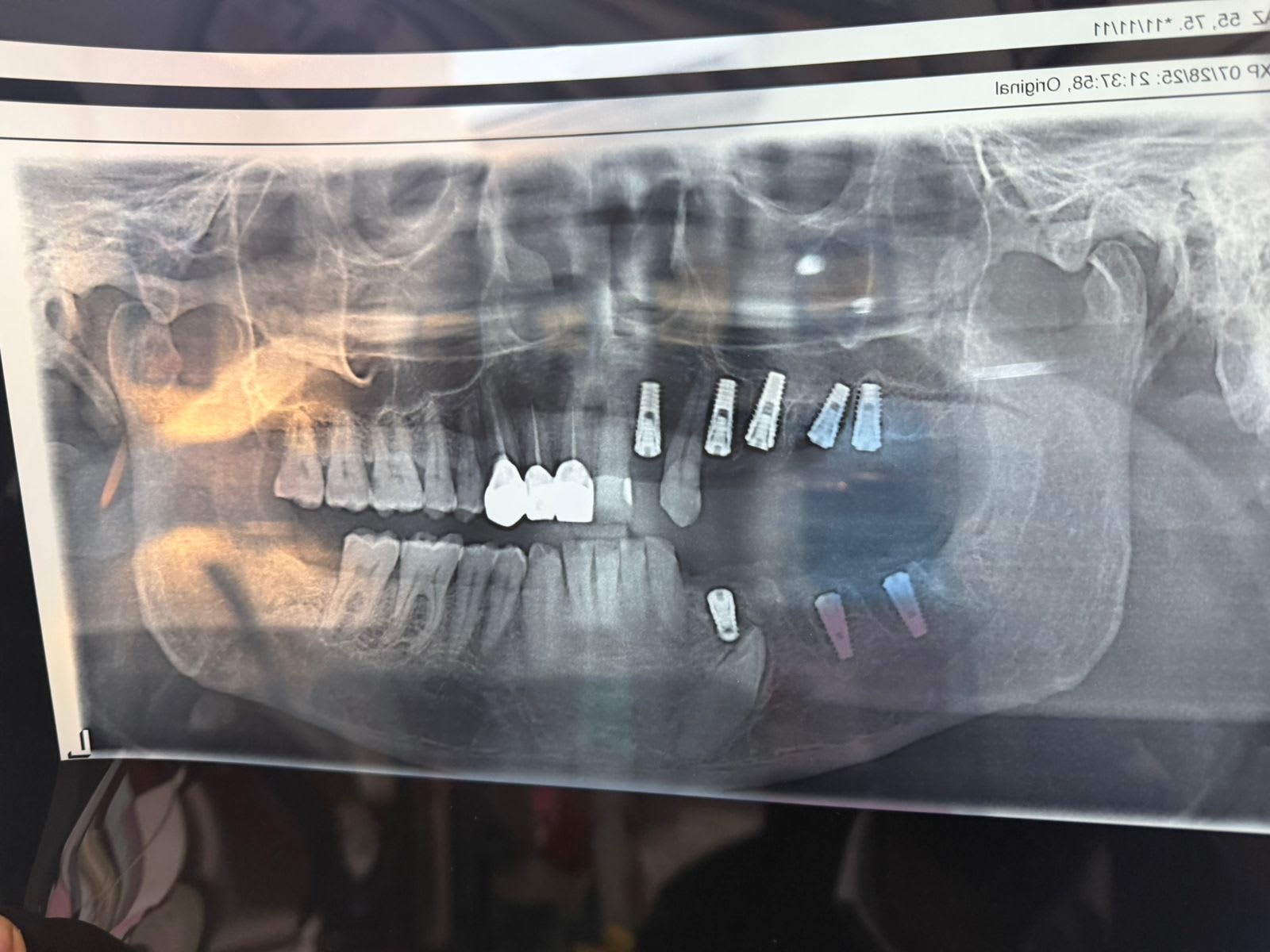 Dental implant restoration completed to replace missing tooth with optimal function, stability, and natural appearance. - Performed at DR. ZEE & Associates