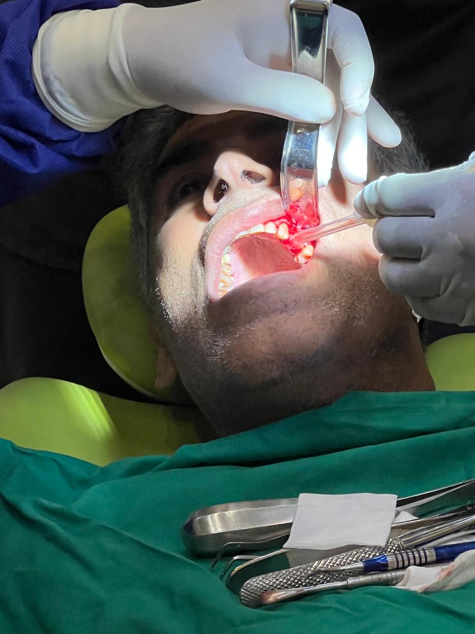 Immediate implant placement with loading performed post-extraction, ensuring minimal treatment time, optimal stability, and natural aesthetic outcome. - Performed at DR. ZEE & Associates