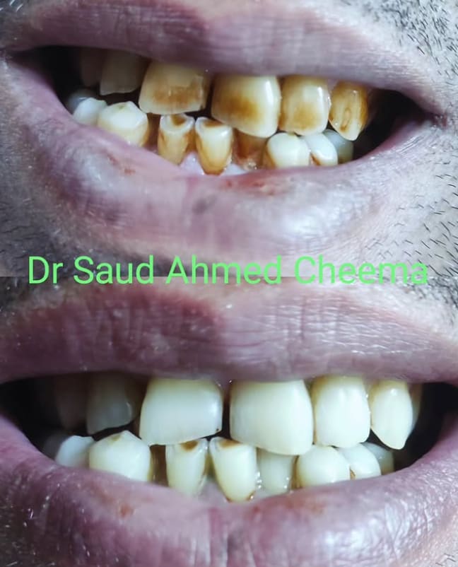 Front teeth restoration to correct staining and structural wear.