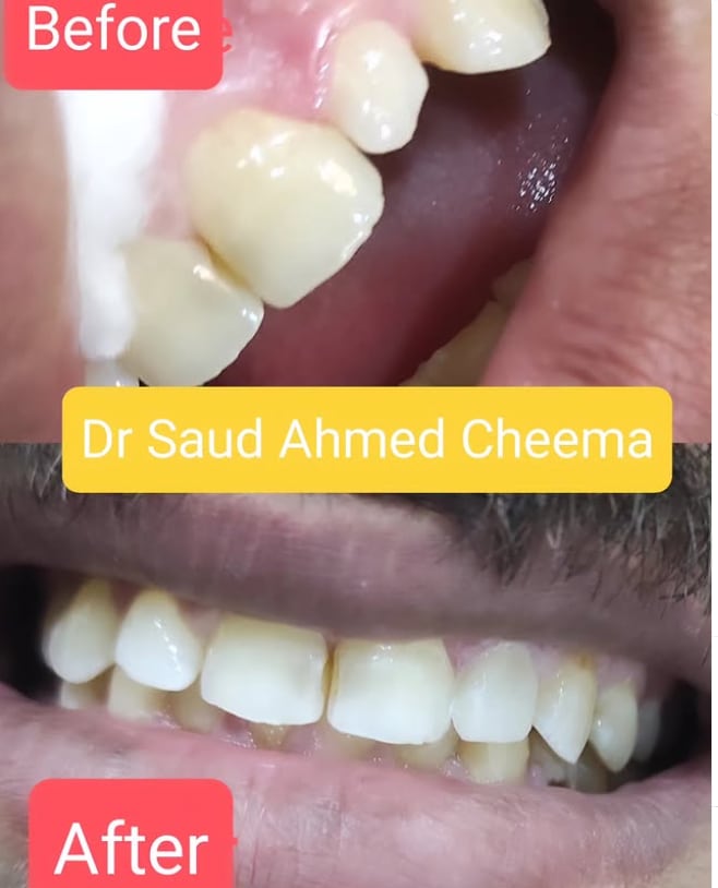 Close-up comparison of single-tooth restoration and whitening on the upper jaw.