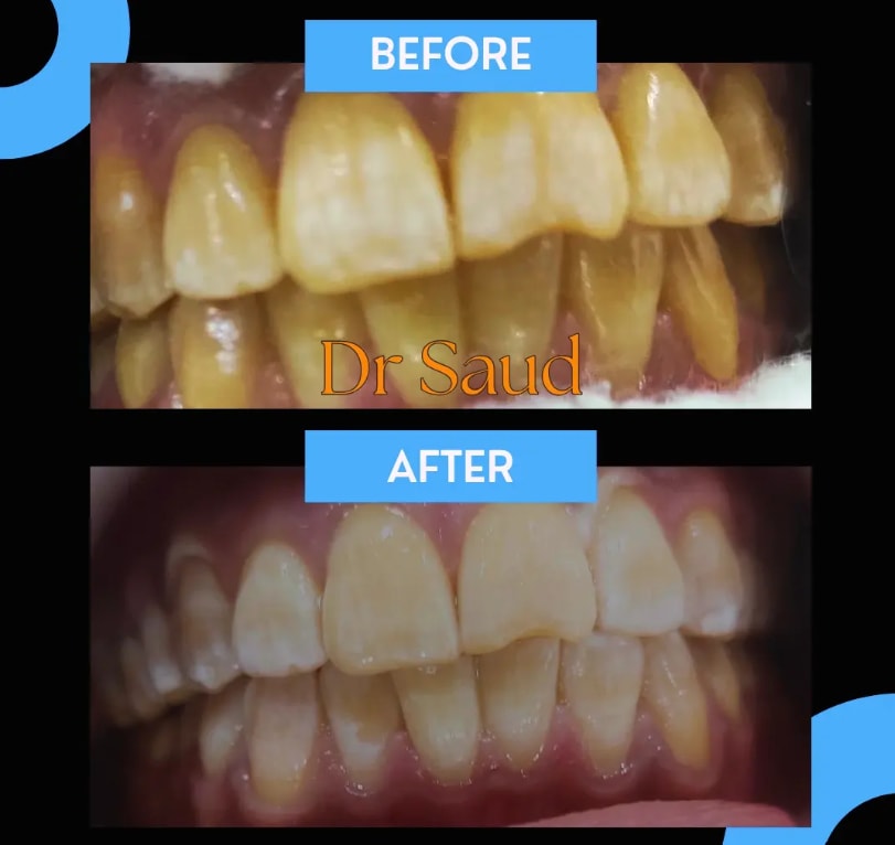Professional teeth whitening improving enamel brightness and reducing discoloration.