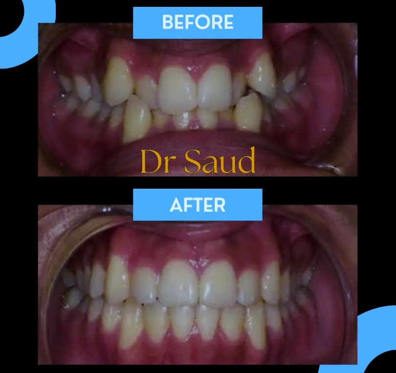 Before-and-after comparison of orthodontic or restorative gap correction.