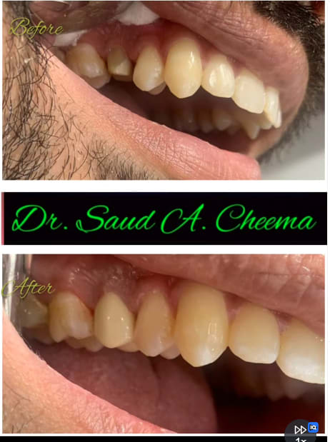 Porcelain crown or veneer placement restoring a chipped and discolored tooth.