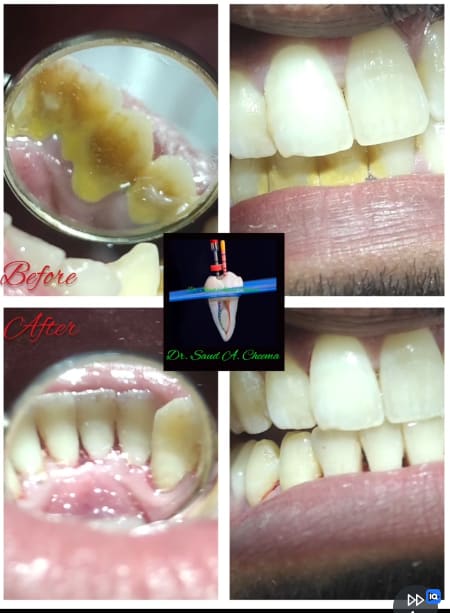 Removal of dental calculus (tartar) deposits from tooth surfaces.