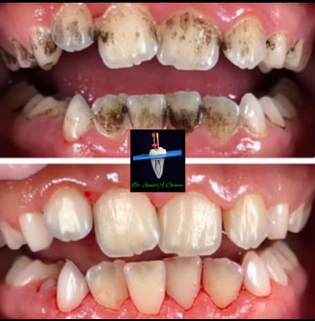 Surface stain removal enhancing the appearance of overall teeth.